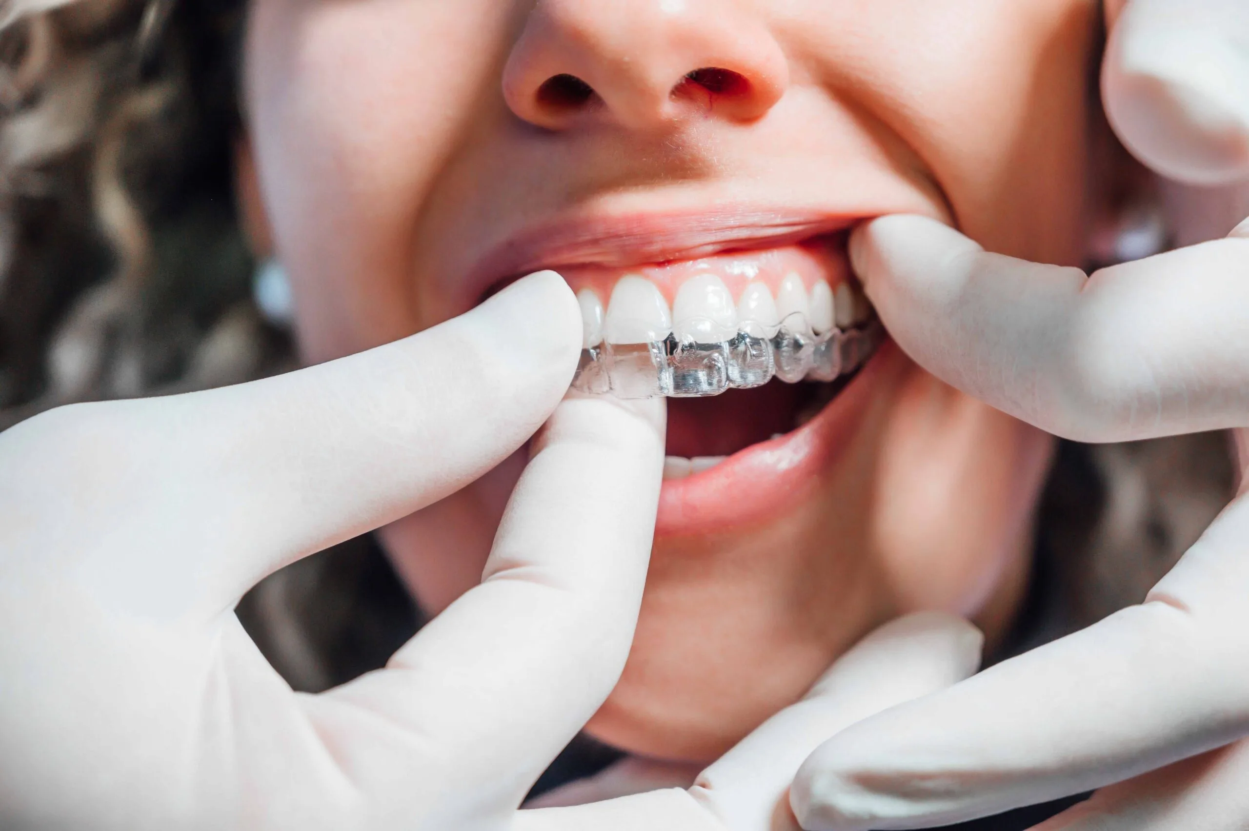 Clear Aligners Treatment in Pune