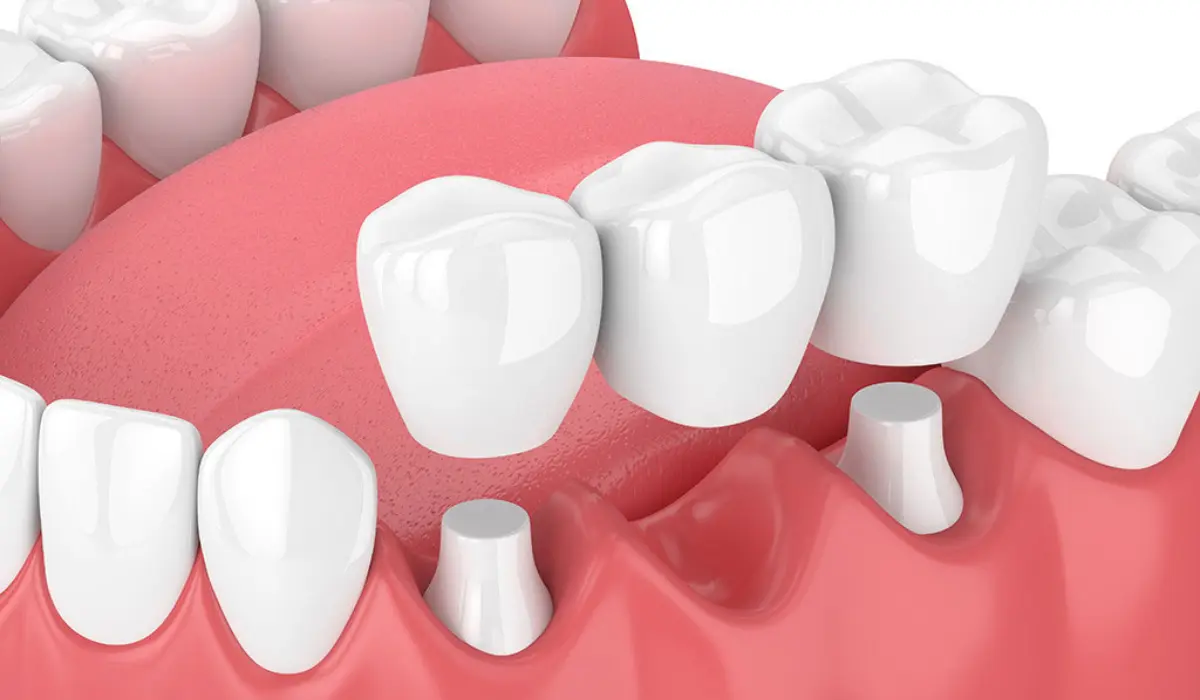 Dental Crown and Bridge Treatment in Pune