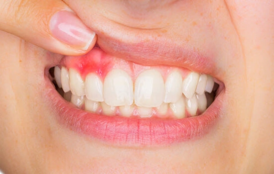 Gum Treatment in Pune