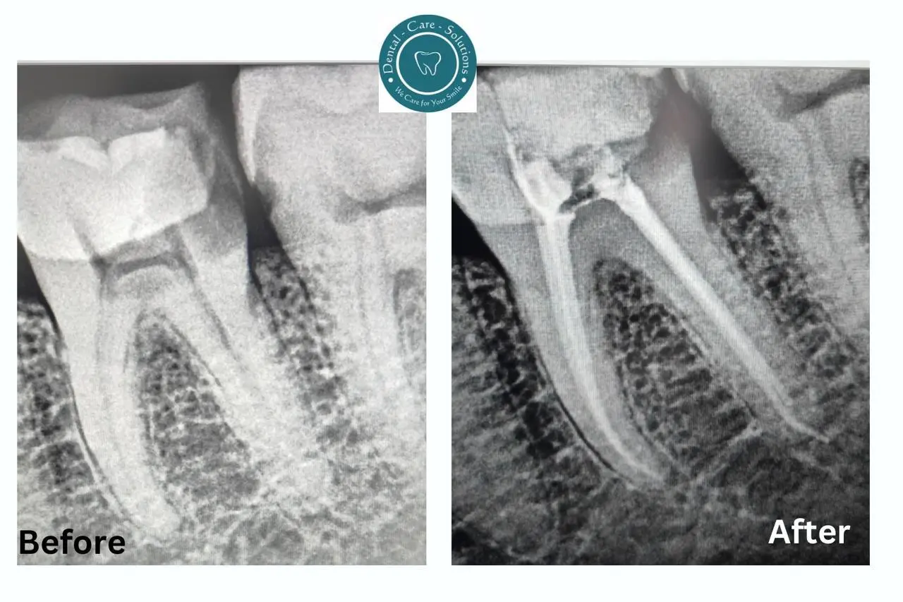 Root Canal Procedure Image 1