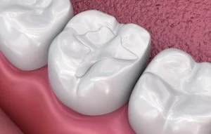 Tooth Colored Filling in Pune