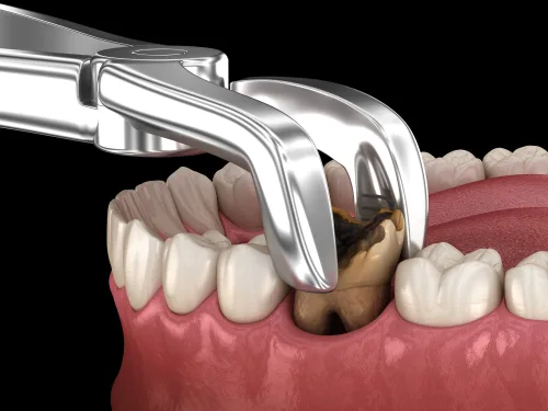 Tooth Extraction in Pune