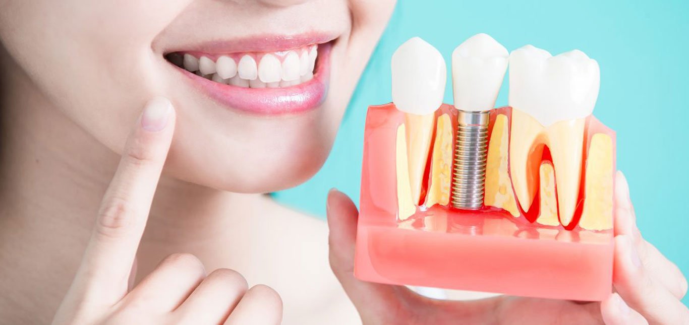 Diagram of dental implant components: implant screw, abutment, and crown.