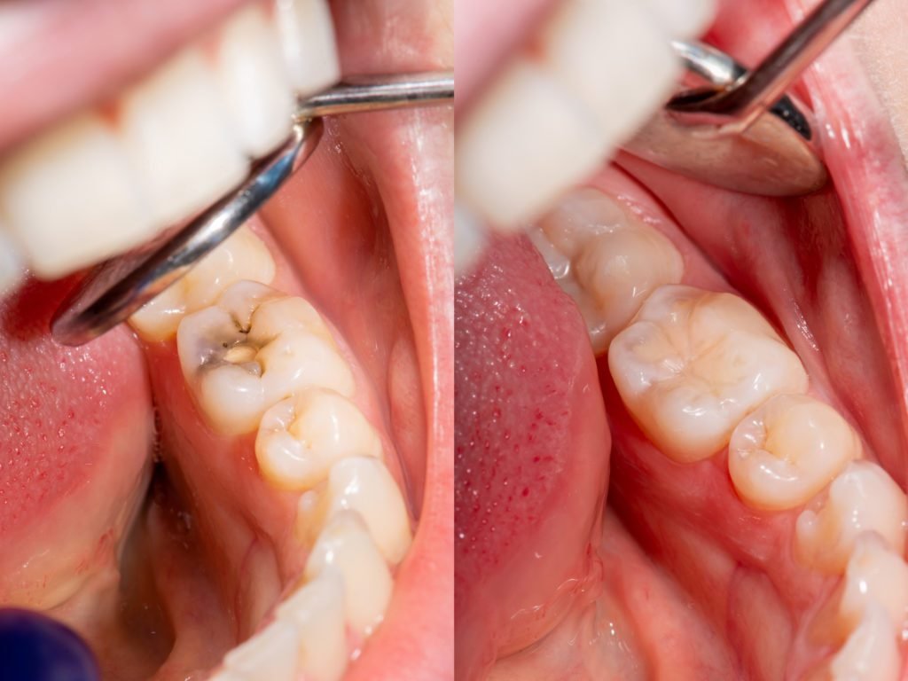 Close-up of tooth-coloured filling being placed on molar tooth during dental procedure