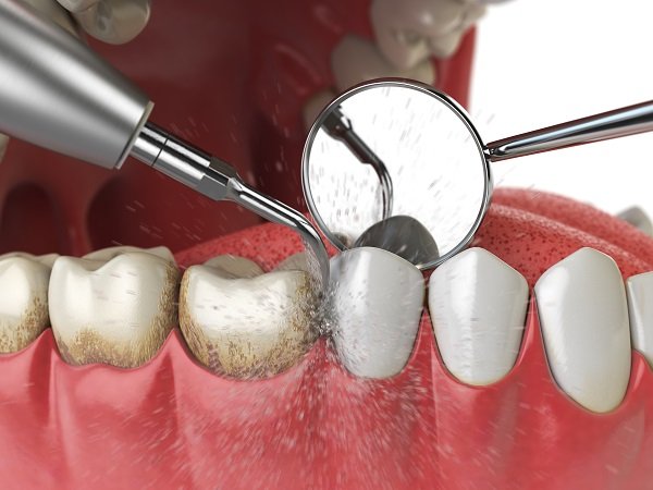 Close-up of professional dental cleaning with scaler and mirror on teeth